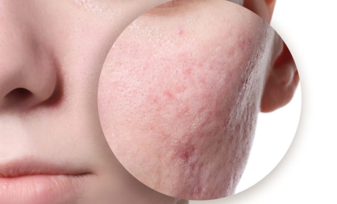 Cicatrizes de Acne