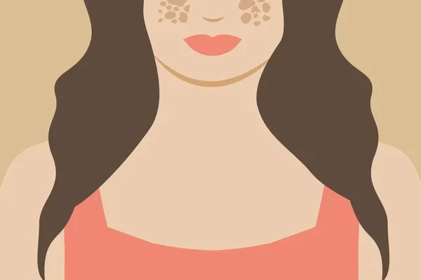 Tratamento de Melasma